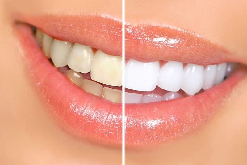 In-office or take-home whitening